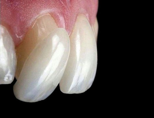 carillas dentales veneers bogota