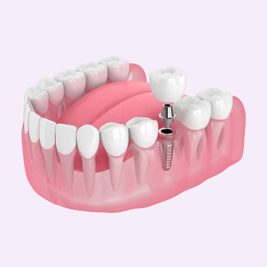 implantes dentales colombia