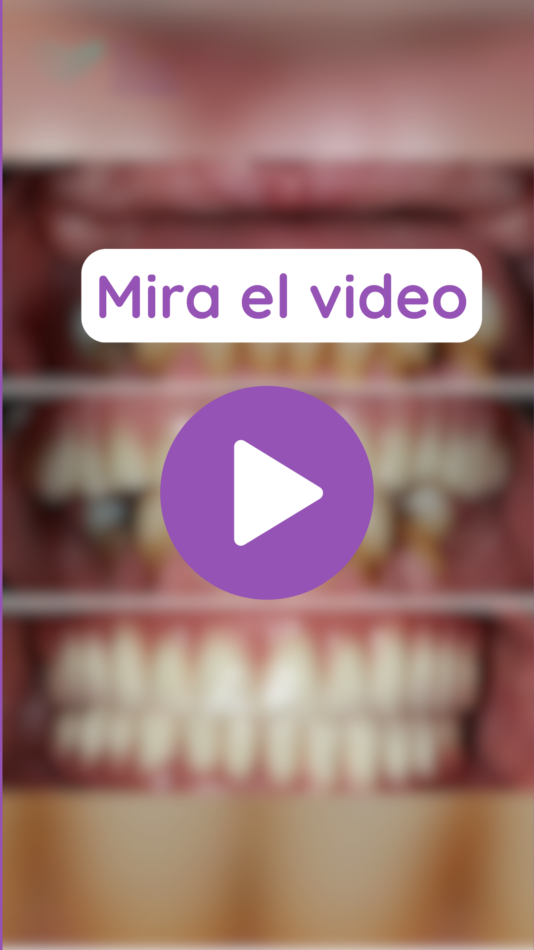 Mira el video de implantes